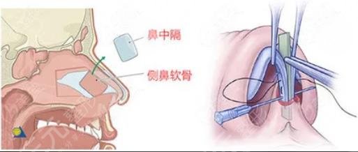 北京李勁良做鼻子價格?貴嗎