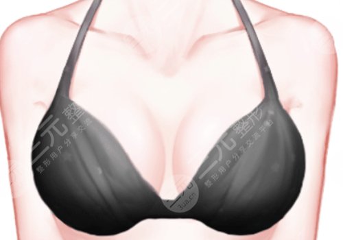 上海九醫(yī)院徐華和王濤乳房再造哪個好