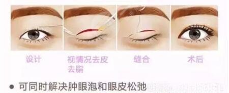 鄭州電力何永強(qiáng)雙眼皮怎么樣？醫(yī)生技術(shù)力介紹、美眼日記匯總！