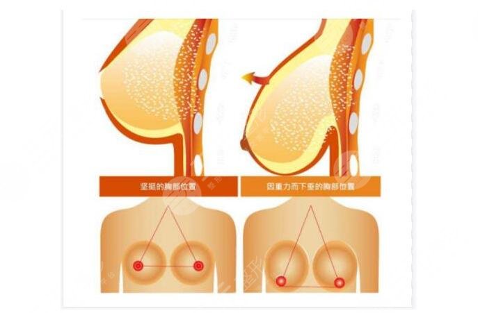 乳房懸吊手術(shù)保持幾年