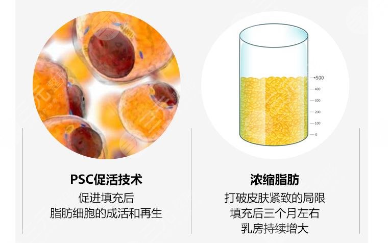 自體脂肪豐胸可靠嗎