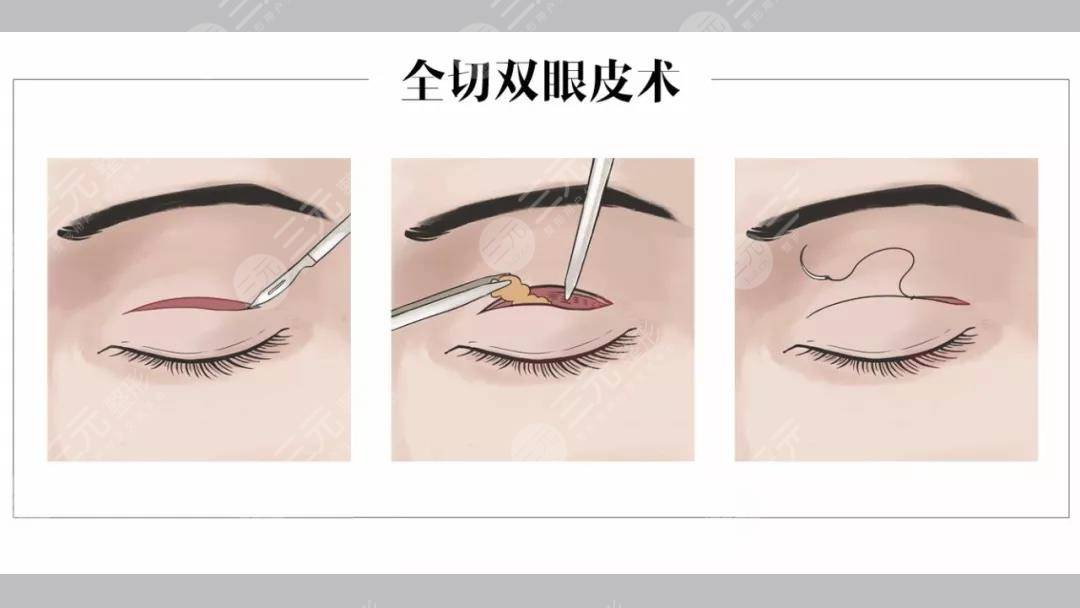 合肥李小靜雙眼皮案例分享！安醫(yī)附院整形實(shí)力派，醫(yī)生風(fēng)格揭秘~