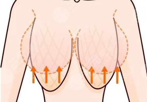 上海華山醫(yī)院縮胸多少錢