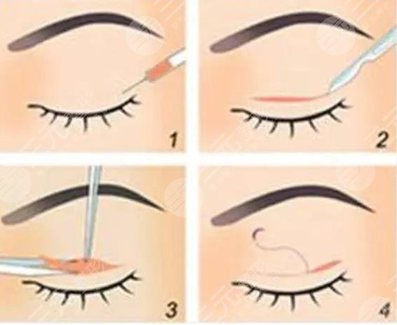 李永忠醫(yī)生眼整形案例