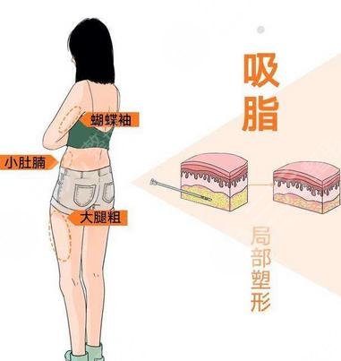 鄭博晨醫(yī)生吸脂案例