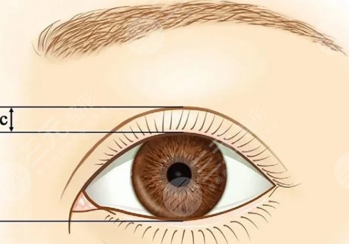 馬菁晶雙眼皮怎么樣