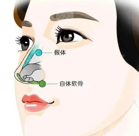 天水四零七醫(yī)院整形美容科假體隆鼻案例