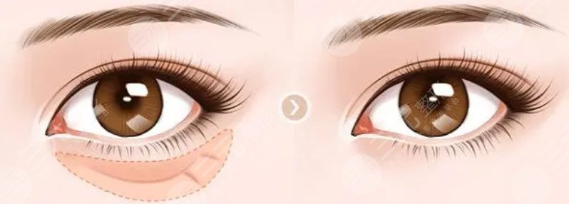 劉波眼袋祛除案例