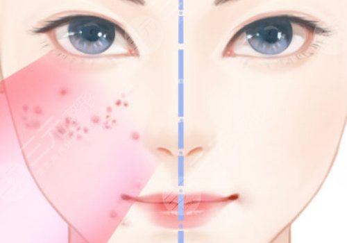 非手術(shù)整形美容