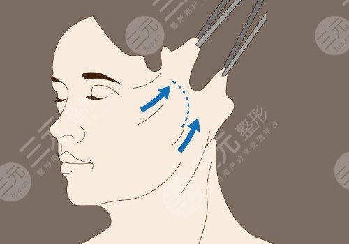 雙眼皮下垂怎么解決