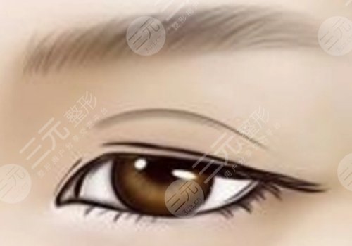 雙眼皮修復是不是重新做一次