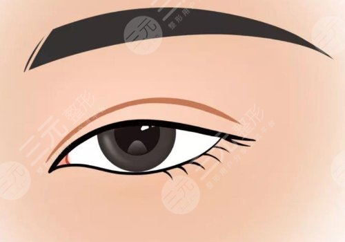 雙眼皮修復是不是重新做一次