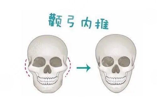 顴骨手術(shù)費(fèi)用一般多少