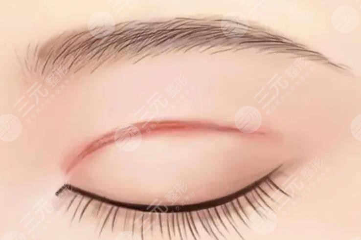 修復(fù)失敗雙眼皮