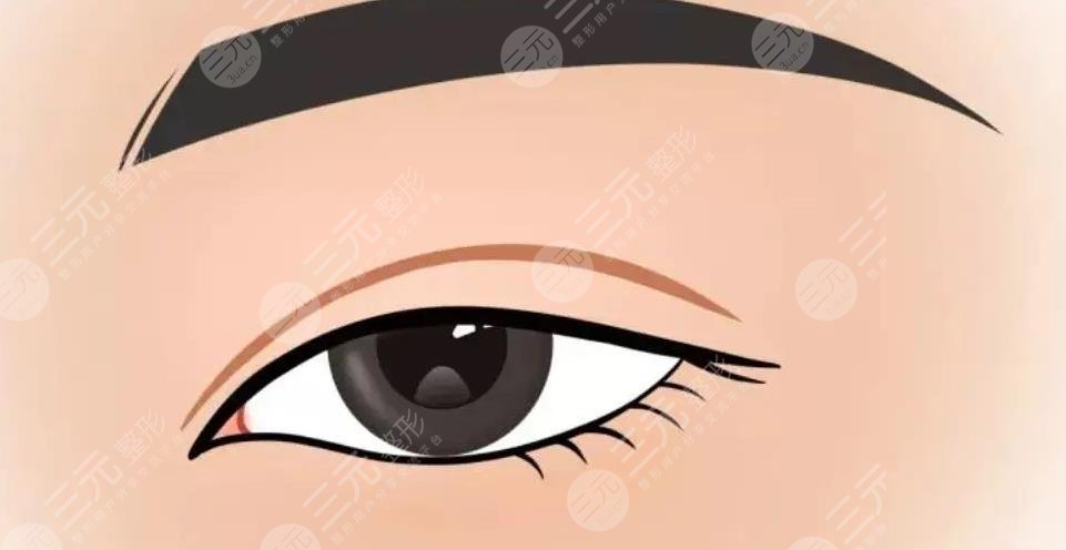 雙眼皮修復(fù)