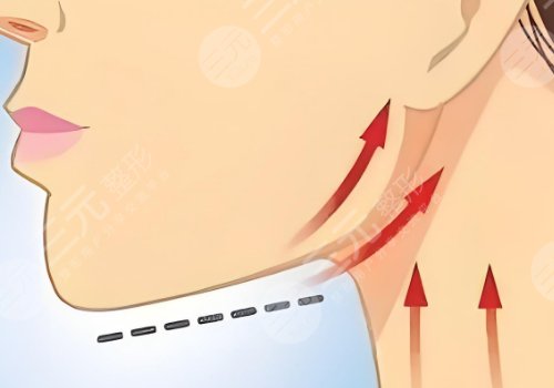 磨下頜骨手術(shù)一般多少錢