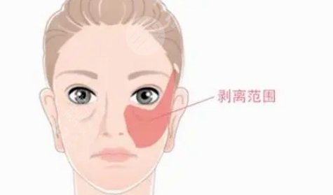 小切口拉皮