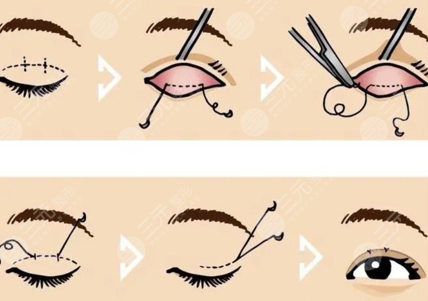  全切雙眼皮1個月恢復(fù)圖