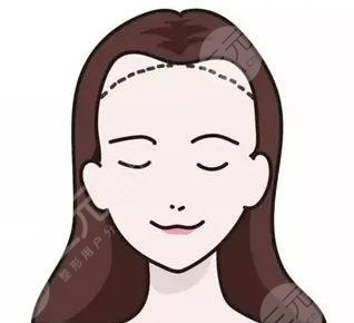 發(fā)際線(xiàn)種植