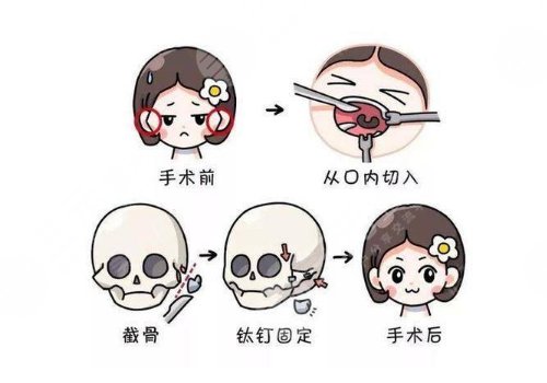 下頜角磨骨手術(shù)需要多少錢