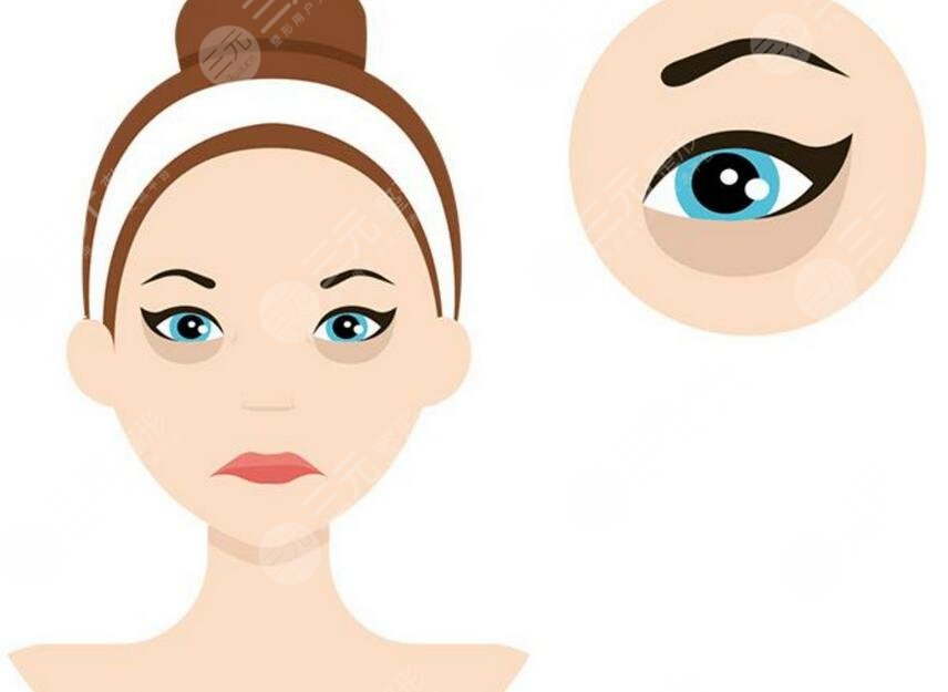 西京醫(yī)院崔江波醫(yī)生祛眼袋案例