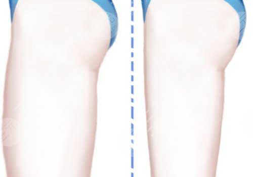 抽脂大腿大約需要多少錢