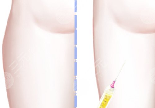 吸脂瘦大腿一般多少錢