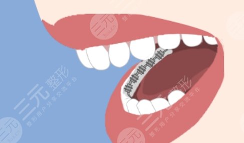 舌側(cè)矯正動漫