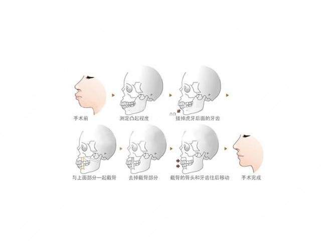 33歲地包天還能矯正嗎