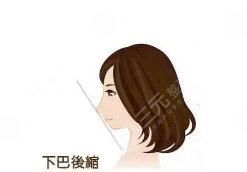 下頜骨手術(shù)費(fèi)用大概多少