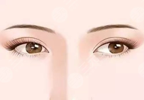 恢復(fù)快的雙眼皮做法是什么