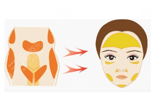 自體脂肪填充全臉大概多少錢