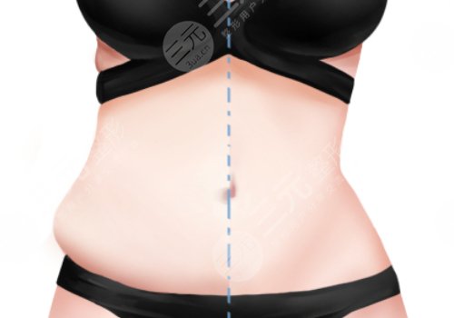 腰部環(huán)形吸脂手術(shù)大概多少錢(qián)