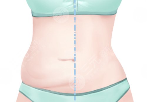 腰部環(huán)形吸脂手術(shù)大概多少錢(qián)