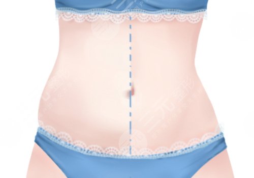 腰部環(huán)形吸脂手術(shù)大概多少錢(qián)