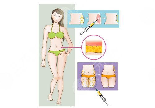 腰腹吸脂多久可以側(cè)身睡覺