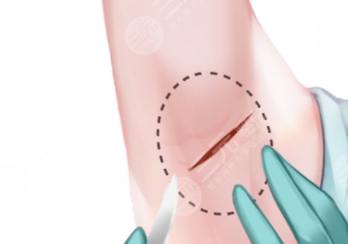 弋磯山醫(yī)院整形美容科和皮膚科做腋下微創(chuàng)手術(shù)—樣嗎