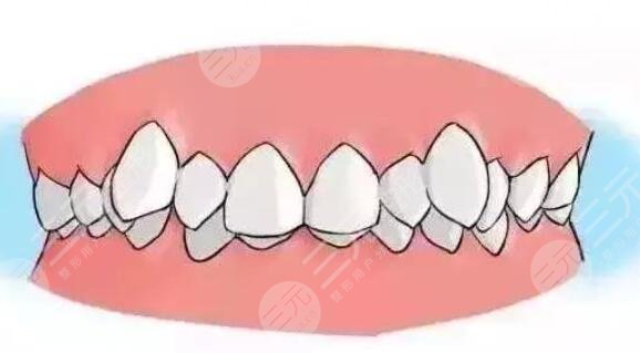 牙齒矯正