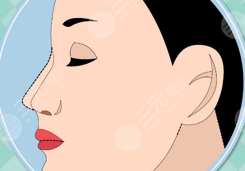 隆鼻膨體價格一般要多少