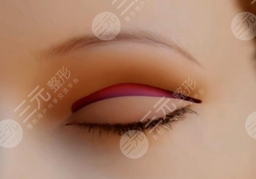 全切雙眼皮可以二次修復嗎