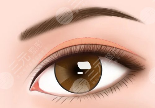 雙眼皮修復(fù)手術(shù)價(jià)格