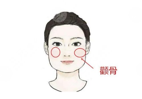 顴骨高怎么整容