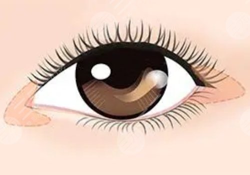 于芷晗醫(yī)生做眼睛價位