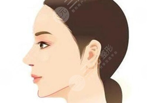 下巴整形多少錢(qián)