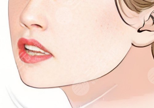 下頜角整形手術費用