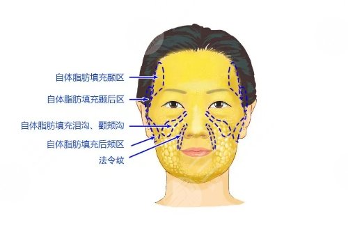 面頰填充用什么填充比較好