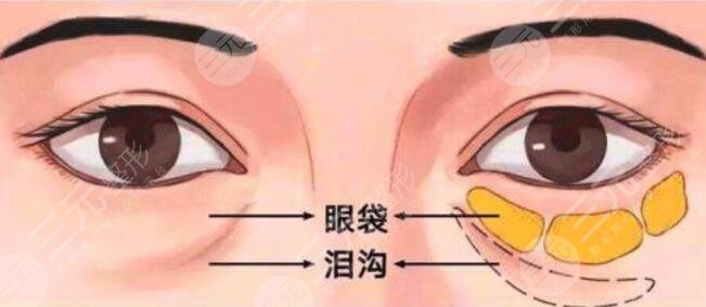 寧波市第六醫(yī)院整復(fù)外科祛眼袋多少錢(qián)?