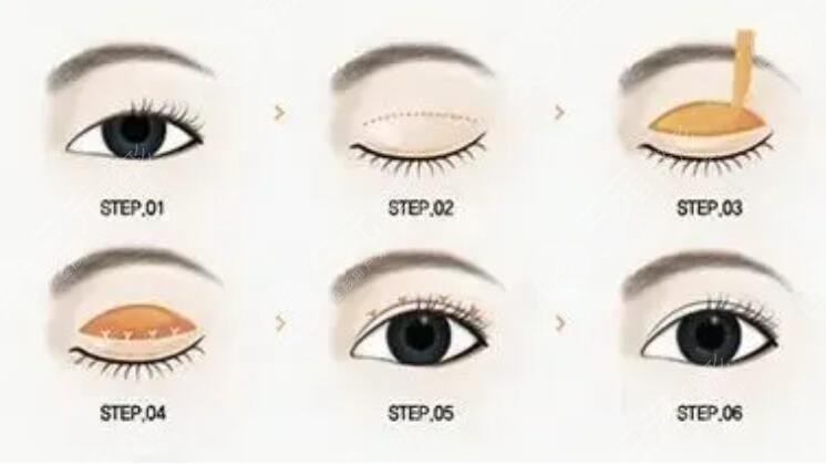 任沖醫(yī)生眼修復怎么樣?