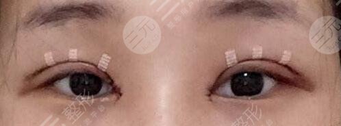 雙眼皮修復術后小tips
