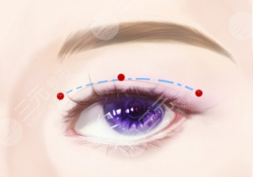 雙眼皮修復(fù)術(shù)后護(hù)理